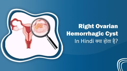 Right Ovarian Hemorrhagic Cyst In Hindi