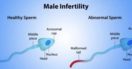 Where there is a will, there is a way: Treatments for Male Infertility - Dr Rita Bakshi