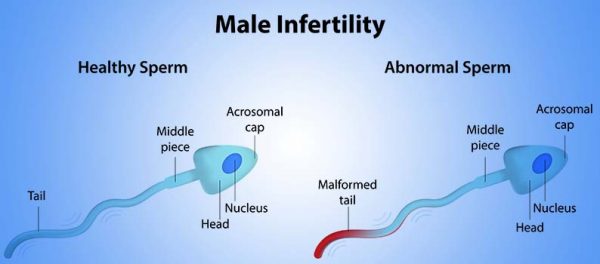 Where there is a will, there is a way: Treatments for Male Infertility - Dr Rita Bakshi