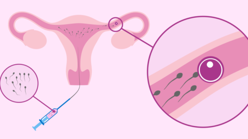How Infertility is Treated Through Intrauterine Insemination? - Dr Rita Bakshi