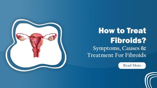 fibroid treatment