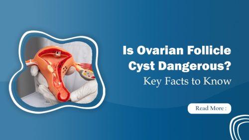 Ovarian Follicle Cyst