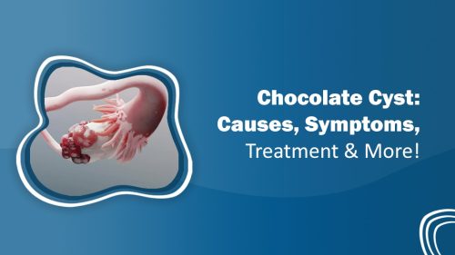 Chocolate Cyst