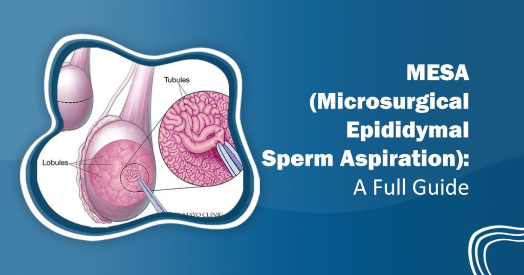 Microsurgical Epididymal Sperm Aspiration (MESA)