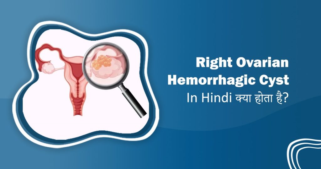 Right Ovarian Hemorrhagic Cyst In Hindi